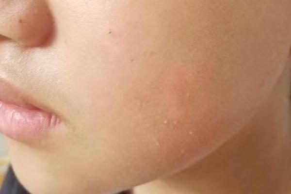 面部上的胎记算命分析 面部上的胎记算命分析