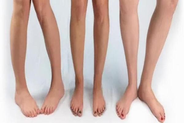 内八字腿型 内八字腿型