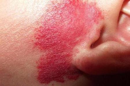 红色的胎记算命