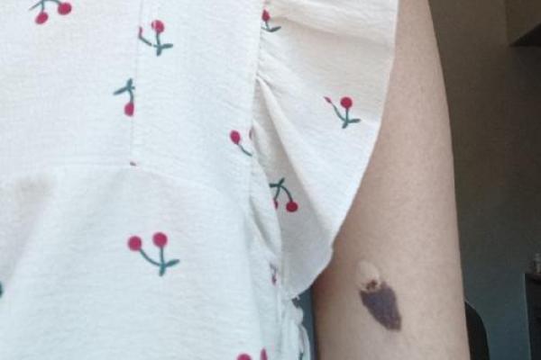 胳膊胎记可以算命吗- 胳膊胎记可以算命吗-