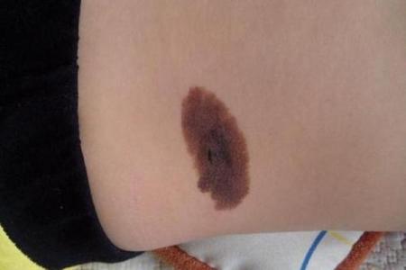 身体上的胎记位置不同算命分析