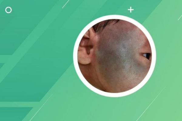 脸上各部位的胎记如何分析算命？