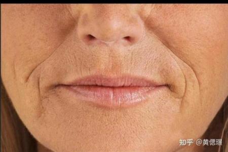 嘴巴八字纹