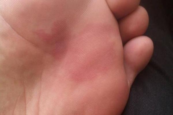 胎记释义，胎记算命中代表什么