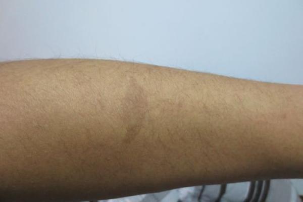 胎记释义，胎记算命中代表什么