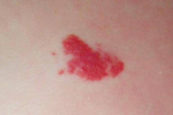 胎记算命图解：什么是红胎记？