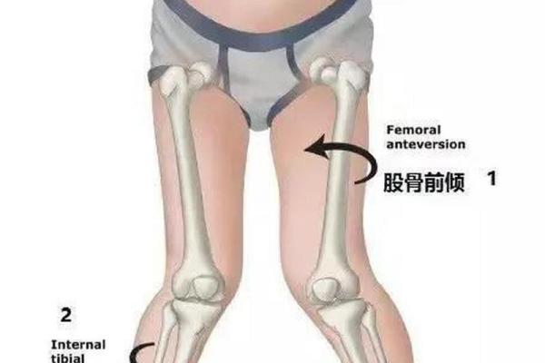 怎样纠正内八字,14岁内八字怎么矫正最快