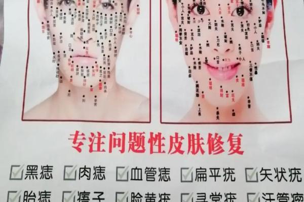 祛痣要算命吗 祛痣要算命吗