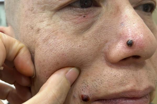 祛痣要算命吗 祛痣要算命吗