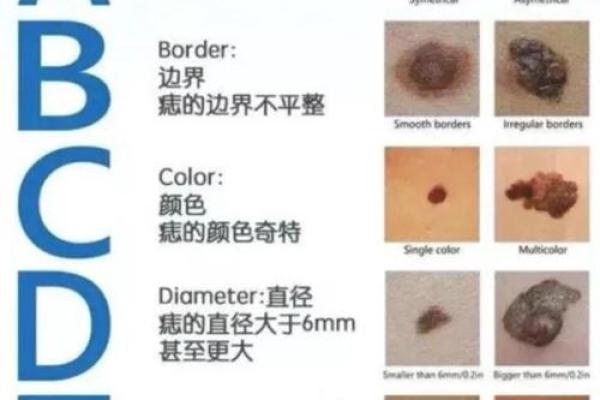 看胎记颜色类型算命 看胎记颜色类型算命