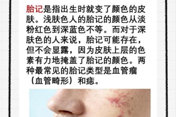 看胎记颜色类型算命 看胎记颜色类型算命