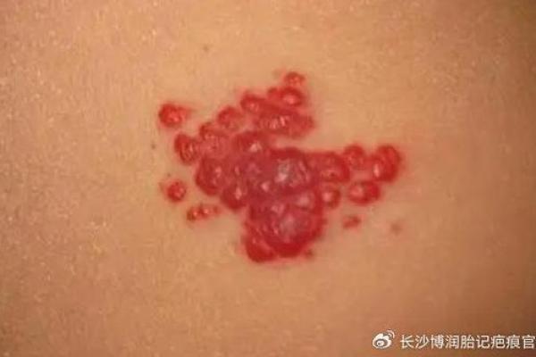 红色胎记算命分析